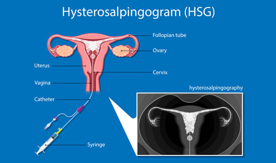 Hysterosalpingography (HSG) for Fertility Diagnosis In Bangalore at Miracle Ivf Hospital 